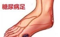 糖尿病足早期症状，糖尿病足如何预防？糖尿病足怎么调理？