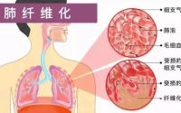 干细胞技术在治疗肺纤维化中的应用
