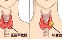 结节囊肿形成的主要原因是什么，结节囊肿吃内消瘰疬丸有用吗？