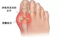 痛风的症状有哪些表现,长期痛风怎么办?