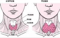 引起甲状腺结节的原因有哪些？甲状腺结节如何调理？