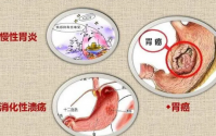 感染幽门螺旋杆菌需要治疗吗？