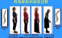 牛骨胶原蛋白肽与预防骨质疏松和促进骨骼生长
