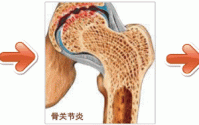 金木同源堂双青胶囊组合补骨髓，双青胶囊组合真能调理好骨关节疾病吗？