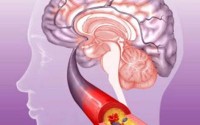 脑血栓病人能吃小分子活性肽吗？如何预防脑血栓？