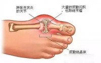 痛风石的表现症状是什么?如何处理痛风石？