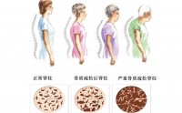 患骨质疏松症不容忽视！干细胞疗法与治疗骨质疏松症！