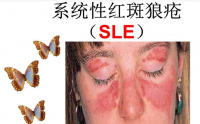 干细胞胞注射疗法在治疗系统性红斑狼疮中的应用