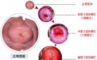 宫颈糜烂如何防护？倍茵舒益生菌抑菌凝胶对宫颈糜烂有效果吗？