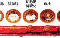 QK纤溶酶能溶血栓吗,QK纤溶酶是什么成分?