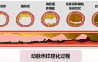 肽是如何修复血管的？再谈小分子肽与动脉粥样硬化