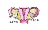卵巢早衰怎么治疗？干细胞疗法与卵巢早衰