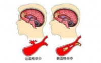 引起脑溢血的原因是什么？脑出血的人可以吃小分子肽吗？