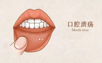 口腔溃疡是什么原因引起的,口腔溃疡怎么缓解?