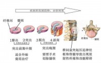 腰间盘突出该怎么治疗好？腰间盘突出怎么调理效果好？