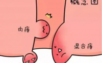 十人九痔，怎么预防痔疮和避免痔疮手术？