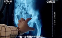 小分子肽对股骨头坏死等骨关节疾病的作用与意义