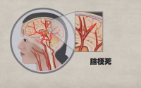 脑梗死、脑血栓及脑出血的区别