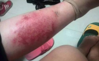 过敏性湿疹症状，严重吗，应该怎么治疗过敏性湿疹？