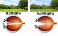 白内障可以吃小分子肽吗，小分子肽对眼睛的营养作用