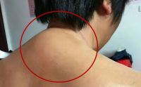  保守治疗富贵包的七种方法——早治疗避免手术