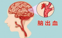 肽对脑溢血的作用,脑溢血后遗症喝小分子肽好吗