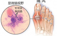 干细胞注射对痛风怎么样？干细胞疗法治疗痛风的作用机理