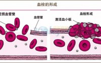 血栓血管堵塞身体会出现哪些现象？吃什么食物预防动脉硬化防血栓？