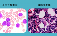 人参牛骨髓肽在骨髓纤维化中营养干预及应用研究