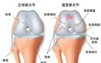 膝关节炎如何调养恢复,吃牛骨胶原蛋白肽有用吗？