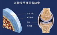 小分子胶原蛋白肽对关节的营养作用，胶原蛋白肽与关节炎