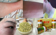 槐米对过敏性鼻炎效果好吗？槐米抗过敏效果