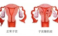 女人腺肌症怎么引起的？如何预防子宫腺肌症？