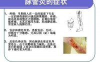 脉管炎是怎么引起的？脉管炎有哪些症状？