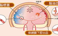 脑梗死病人治疗一定不可忽视化痰祛湿