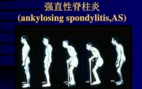 治疗类风湿、股骨头坏死、强直性脊柱炎常用药物作用原理及其副作用