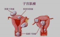 子宫肌瘤是怎么引起的？子宫肌瘤能吃大豆肽吗？子宫肌瘤吃小分子肽有用吗？