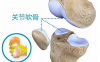 牛骨胶原蛋白肽与关节炎和软骨损伤