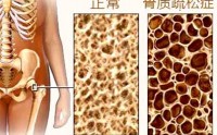 为什么会得骨质疏松症？骨质疏松症如何预防治疗？
