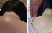 富贵包出现的原因？怎么治疗富贵包？富贵包健康管理