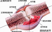 牛骨胶原蛋白肽修复骨关节炎软骨损伤的效果好吗？
