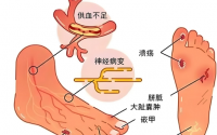 糖尿病足发病因素,糖尿病足如何预防?