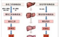 慢性肝炎的症状及表现,慢性肝炎可以治愈吗?