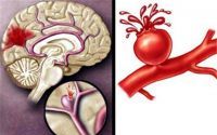 脑溢血是怎么引起的？小分子肽对脑溢血的作用！