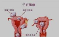 子宫肌瘤是怎么引起的？子宫肌瘤能吃大豆肽吗？子宫肌瘤吃小分子肽有用吗？
