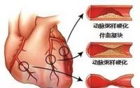 地龙蛋白肽可以防治冠状动脉粥样硬化吗？地龙蛋白对心血管病有什么作用？