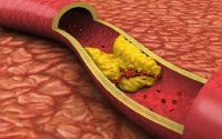 动脉粥样硬化会引起哪些疾病？干细胞与治疗动脉粥样硬化的作用！