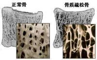 骨质疏松补钙可以吗？改善骨质疏松增加骨密度还需要骨胶原肽来促进钙吸收！