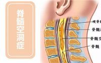 脊髓空洞症是什么原因引起的,脊髓空洞症的症状,如何预防调理脊髓空洞？