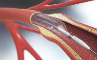 造成血管堵塞的主要原因是什么？